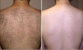 Achieve Silky Smooth Skin with Laser Hair Removal in Dubai