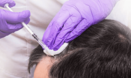 PRP Hair Treatment for Thinning Hair