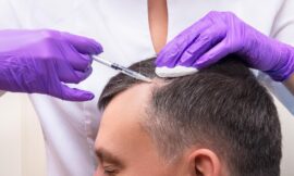 Does PRP Hair Treatment Work on Bald Spots?