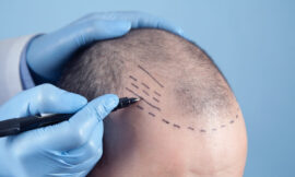 Hair Transplant Procedures Available in Riyadh