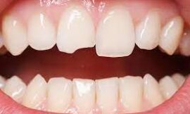 Dental Bonding Cement, A Simple Solution for Cracked Teeth