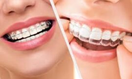 Best Dentist for Braces in Bangalore