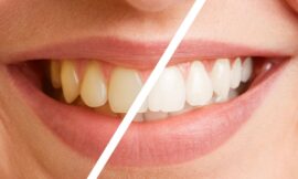 Brighten Your Teeth with the Power of Zoom Whitening