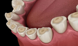 Teeth Grinding and TMJ, How They’re Connected