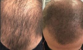 Can People with Alopecia Benefit from Micro Scalp Pigmentation