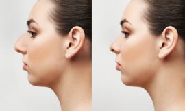 Can Rhinoplasty in Dubai Help With a Deviated Septum