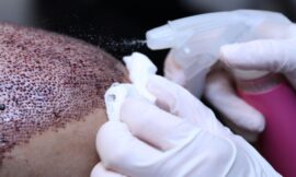 How Much Does a Successful Hair Transplant Cost?