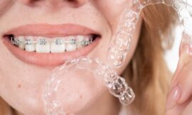 Perfect Your Smile with Clear Aligners