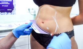 Freeze Your Fat Away: The Magic of CoolSculpting