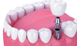 Dental Implants vs. Bridges Which is Better in Dubai