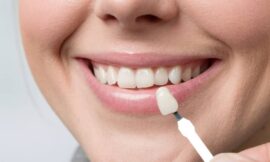 Achieving Smile Perfection: The Role of Dental Veneers Explained