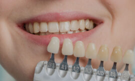 Dental Veneers Care: Key Tips for Keeping Them in Great Shape