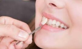 How Do Dental Veneers Improve My Smile in Dubai?