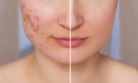 Do Acne Scar Treatments Work on Sensitive Skin Without Causing More Breakouts