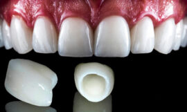 E-Max Veneers, Strong, Durable, and Beautifully Thin