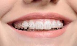 Is Metal Braces Right for You, Here’s What to Consider