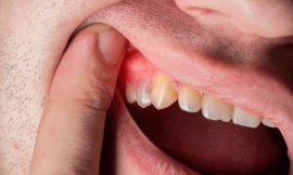 Why You Should Consider Gingivectomy for Gum Problems