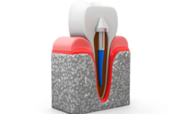 The Ultimate Guide to 1 Day Dental Implants with Texas Sedation Dental