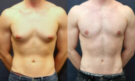 Best Doctors in Dubai for Gynecomastia: How to Choose the Right Expert