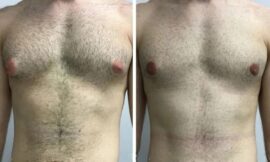 Gynecomastia in Dubai: Is Surgery the Right Choice for You?