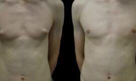 Best Doctors in Dubai for Gynecomastia: Top Clinics Offering Advanced Procedures