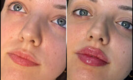 Best Plastic Surgeon in dubai for Fillers: How to Maintain Long-Lasting Results