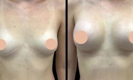 Factors to Consider Before Choosing Breast Augmentation in Dubai