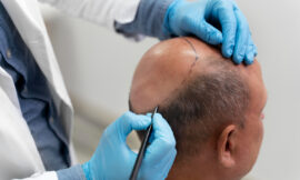 Why Hair Transplant Is Becoming More Affordable