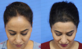 Which is the best hair transplant in India?