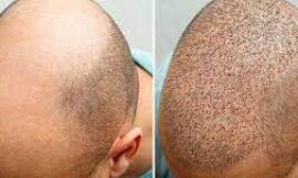 Can Anyone Get a Hair Transplant in Dubai?