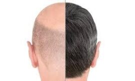 Hair Transplant in Dubai: Price vs. Quality – What Matters Most?