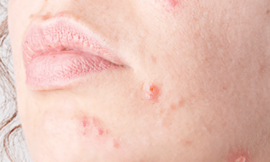 How Can Actinic Keratosis Treatments Be Tailored to My Skin Type in Dubai