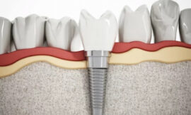 How Dental Implants Support Gum Health