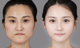 How Does Plastic Surgery in Dubai Compare to Other Countries