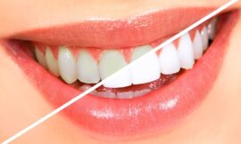 How Does Zoom Teeth Whitening in Dubai Compare to Other Methods