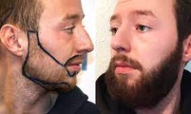 How Much Downtime Should I Expect After a Beard Hair Transplant in Dubai