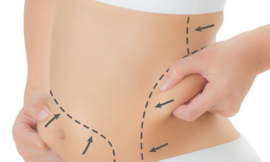 How Should I Prepare for Liposuction Surgery