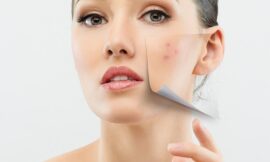 How to Get Rid of Acne Scars Fast in Dubai Expert Tips & Tricks