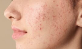 How Long Can You Expect Acne Treatments to Show Improvement?