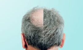 Where to Get the Best Hair Transplant in Dubai?