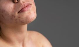 Is Acne Treatment Safe for People with Psoriasis?