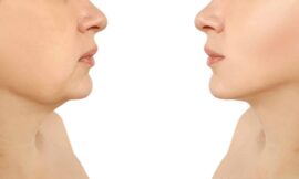 Is Double Chin Liposuction Suitable for Older Adults?