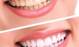 Is Teeth Whitening in Dubai Suitable for People with Braces