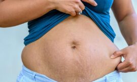 How Many Laser Sessions Are Needed for Stretch Marks?