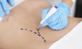 Liposuction Explained: What Every Beginner Should Understand