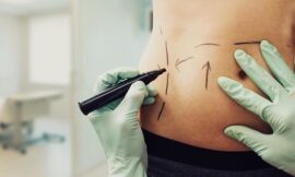 What to Expect During a Liposuction Procedure