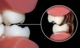 Managing Teeth Grinding, What You Need to Know