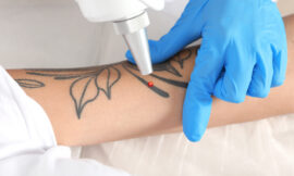 Exploring PicoSure Tattoo Removal: Facts and Frequently Asked Questions