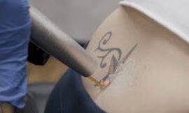 Navigating the PicoSure Laser Tattoo Removal Process