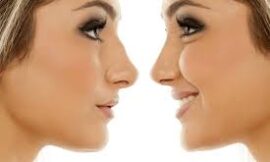 Male Rhinoplasty in Dubai: What You Should Know